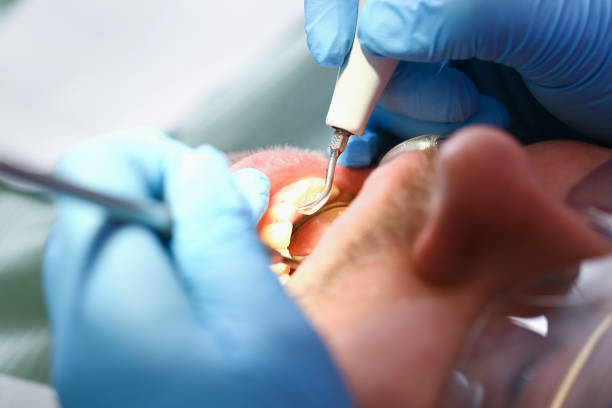 Best Emergency Wisdom Teeth Removal in Brook Park, OH